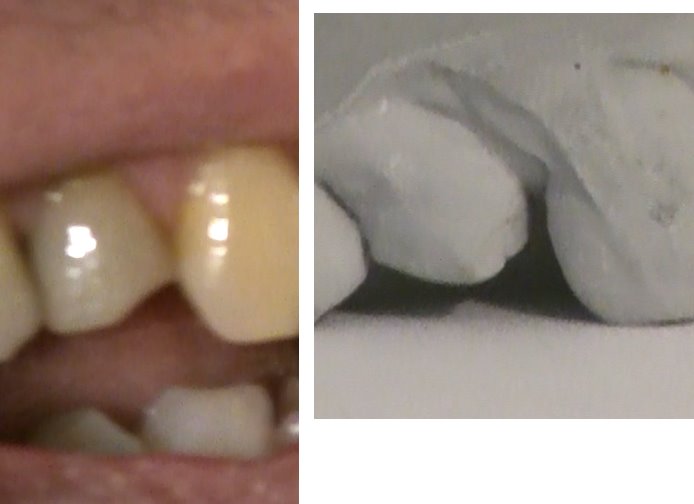 Crown done by Brucegate Dental Practice alongside a plaster cast from 2010